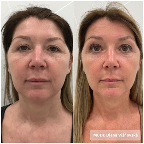 Porovnanie pred a po Ultherapy®