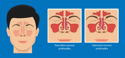 Infografika: Príčiny vybočenej nosovej priehradky