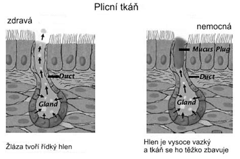 Ilustrácia: Orgány postihnuté cystickou fibrózou