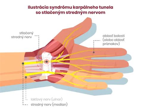 Anatomická schéma karpálneho tunela