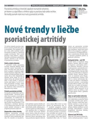 Postihnutie kĺbov pri psoriatickej artritíde