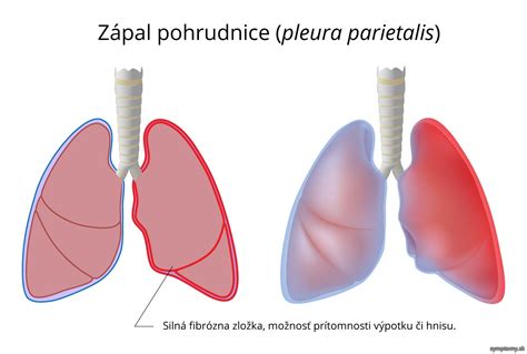 Anatómia pleury a jej zápal