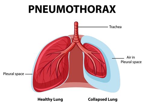 Druhy pneumotoraxu