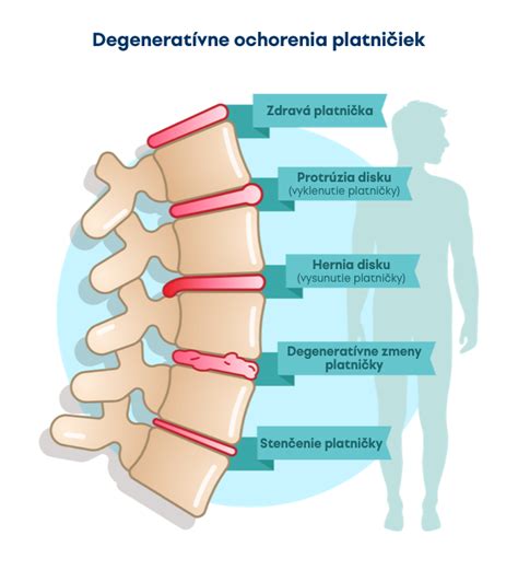 Vizualizácia chrbtice s vysunutou medzistavcovou platničkou