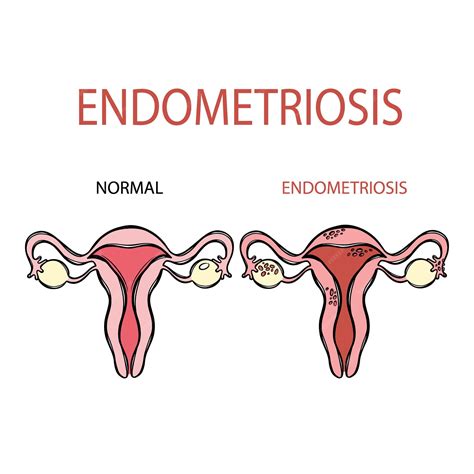 Schéma rastu endometria mimo maternice