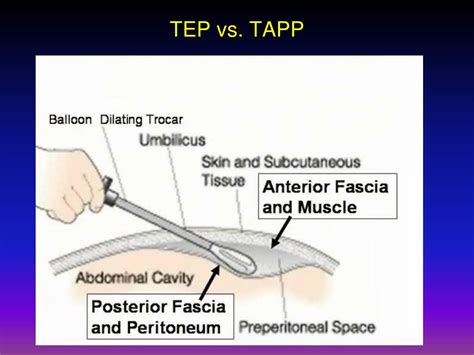 Porovnanie laparoskopických techník (TAPP vs TEP)