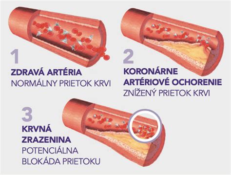 Schéma koronárnych artérií a aterosklerotického plátu