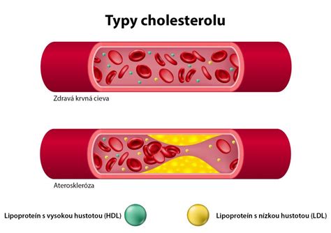 Vplyv cholesterolu na tepny