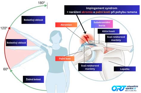 Infografika zobrazujúca tri fázy zmrznutého ramena s časovými osami a typickými príznakmi