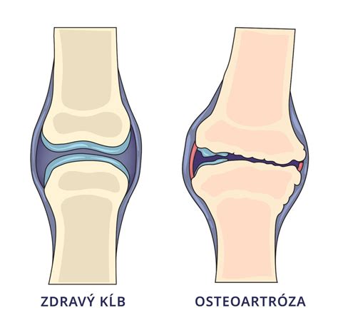 Porovnanie zdravého kĺbu, kĺbu s osteoartritídou a kĺbu s reumatoidnou artritídou
