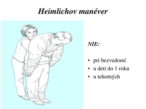 Schéma: Heimlichov manéver