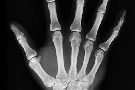 Röntgenový snímok s implantovanou bedrovou endoprotézou