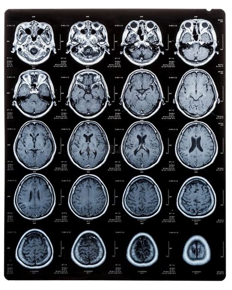 Porovnanie CT a MRI snímok mozgu