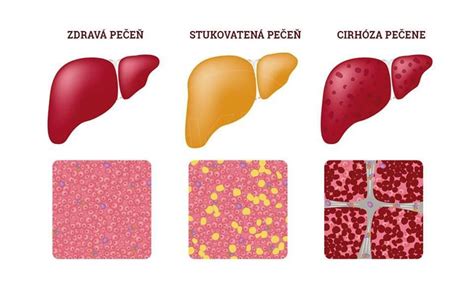 Schéma príčin cirhózy pečene