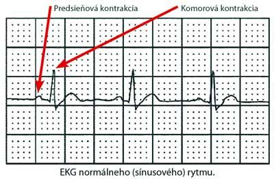 Graf EKG záznamu s priebehom fibrilácie predsiení, defibrilačným výbojom a následným sínusovým rytmom