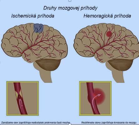 Schéma diagnostického procesu pri cievnej mozgovej príhode