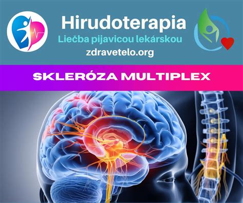 Zobrazenie centrálneho nervového systému pri skleróze multiplex