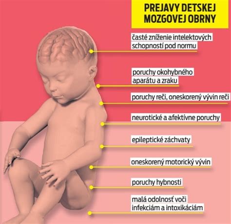 Infografika príčin detskej mozgovej obrny