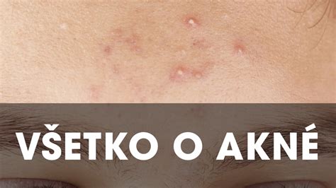 Schéma vzniku akné: upchatie pórov, zápal, tvorba vyrážok