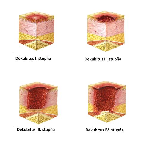 Schéma: Stádiá dekubitov