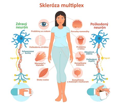 Príznaky roztrúsenej sklerózy - infografika