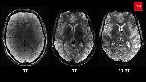 Zobrazovacie metódy mozgu (MRI, CT)