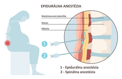 Ilustrácia zavedenia epidurálneho katétra