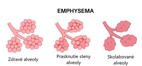 Schematické znázornenie pľúcnych mechúrikov (alveolov)