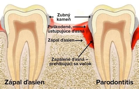 Porovnanie zdravých ďasien a ďasien postihnutých gingivitídou a parodontitídou