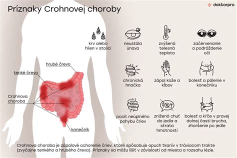 Schéma komplikácií Crohnovej choroby