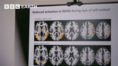 Mozog človeka s ADHD