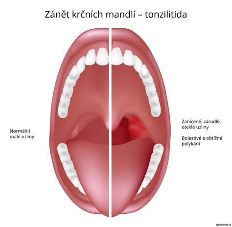 Zápal krčných mandlí