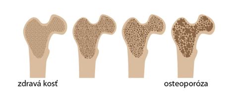 Ilustrácia rôznych ochorení kĺbov a kostí (artróza, osteoporóza, zápal)
