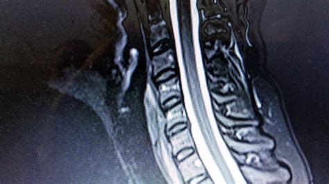 Ukážka MRI snímky krčnej chrbtice s myelopatiou