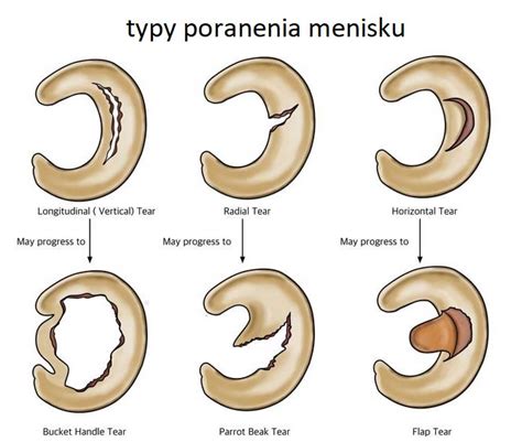 Rôzne typy poranení kolena