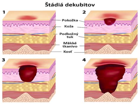 Typy dekubitov a ich štádiá
