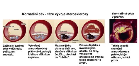 Aterosklerotický plak v cieve