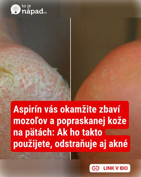 Detailné zobrazenie popraskanej suchej kože