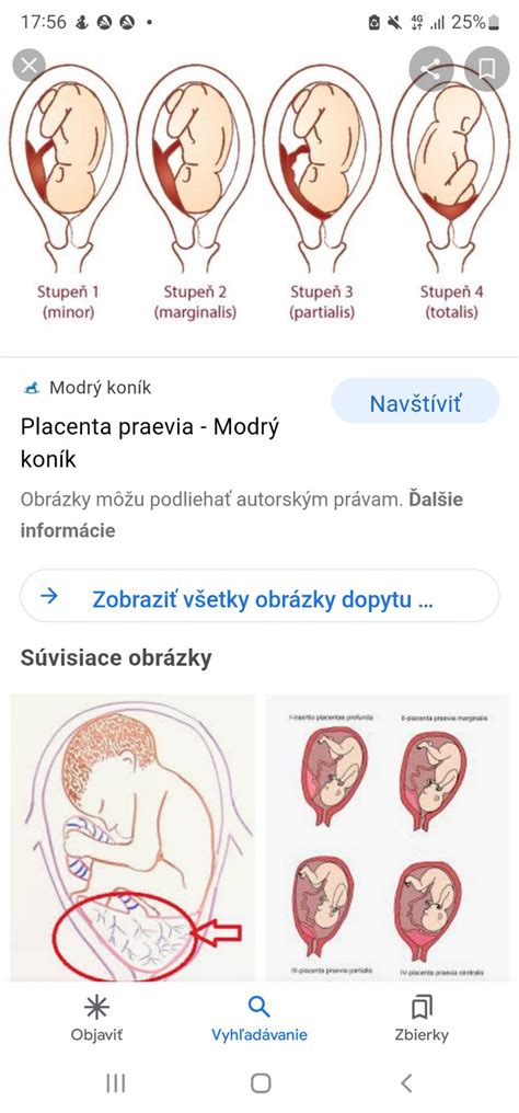 Schéma pôrodných ciest