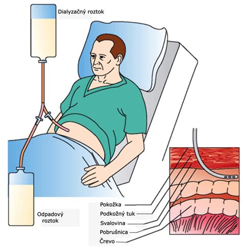 Infografika znázorňujúca proces domácej peritoneálnej dialýzy