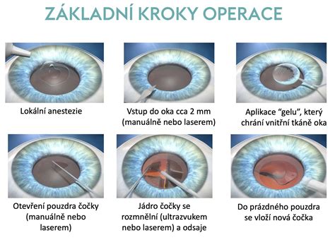 Operácia šedého zákalu