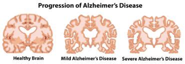 Ilustrácia mozgu s Alzheimerovou chorobou