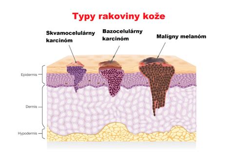Schéma: Možnosti liečby rakoviny kože v závislosti od štádia