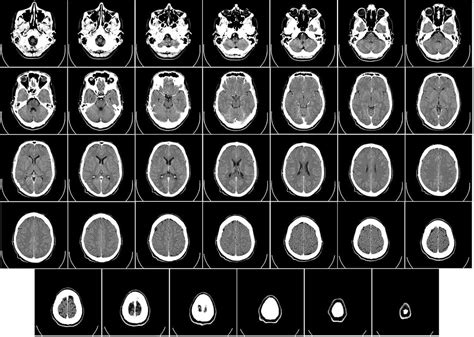 Porovnanie CT a MRI snímkov mozgu pri úraze
