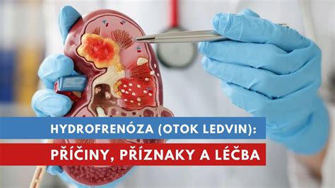 Schéma ureterokély spôsobujúcej hydronefrózu