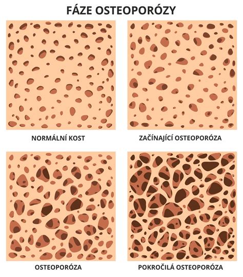 Rizikové faktory osteoporózy