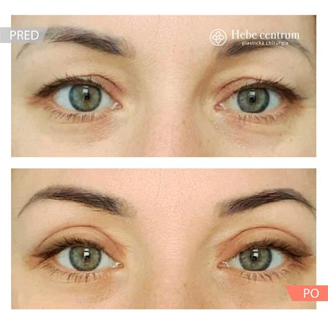 Detail hojacej sa jazvy po blefaroplastike