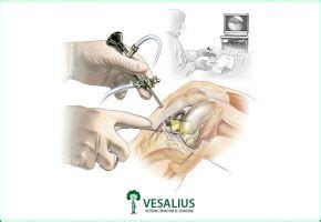 Artroskopia kolena - schéma