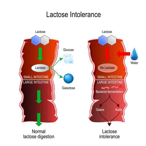 Diagnostika intolerancie laktózy