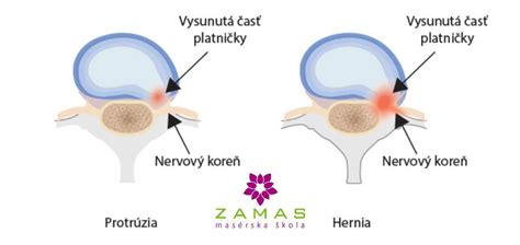 Zúženie miechového kanála spôsobené cervikálnou myelopatiou